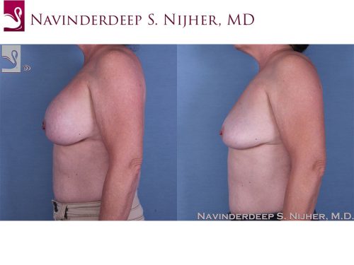 Breast Revisions Case #60683 (Image 3)