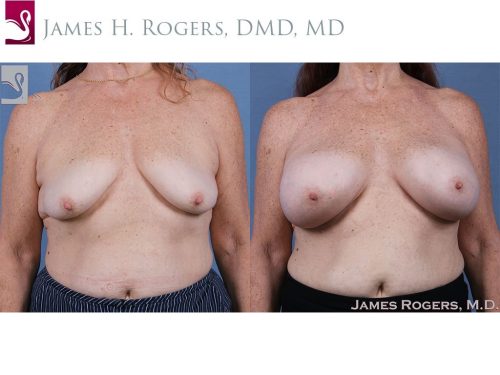 Breast Augmentation Case #61426 (Image 1)