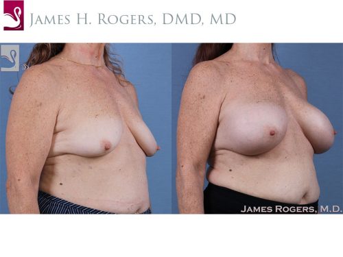 Breast Augmentation Case #61426 (Image 2)