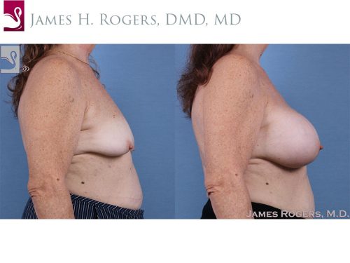 Breast Augmentation Case #61426 (Image 3)