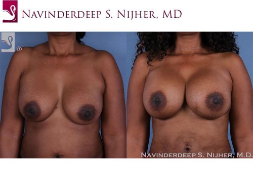 Breast Revisions Case #53643 (Image 1)