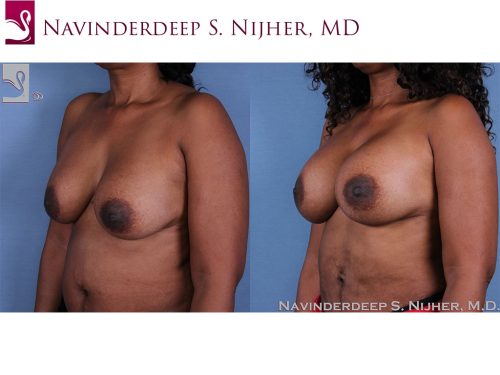 Breast Revisions Case #53643 (Image 2)