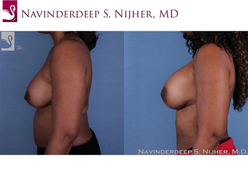 Breast Revisions Case #53643 (Image 3)
