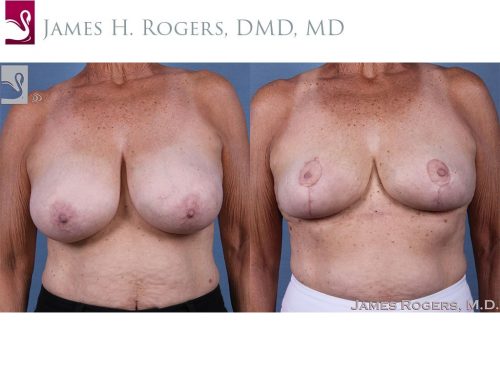 Female Breast Reduction Case #61572 (Image 1)