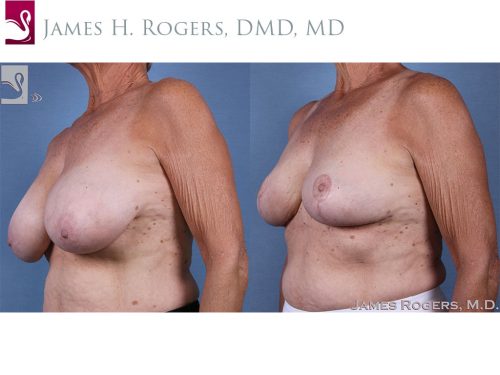 Female Breast Reduction Case #61572 (Image 2)
