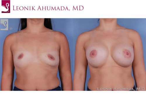 Breast Augmentation Case #61701 (Image 1)