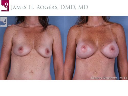 Breast Augmentation Case #42239 (Image 1)