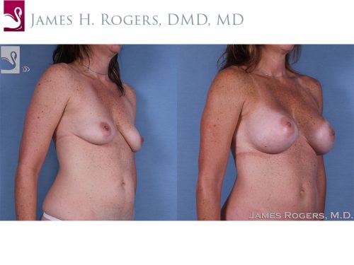 Breast Augmentation Case #42239 (Image 2)