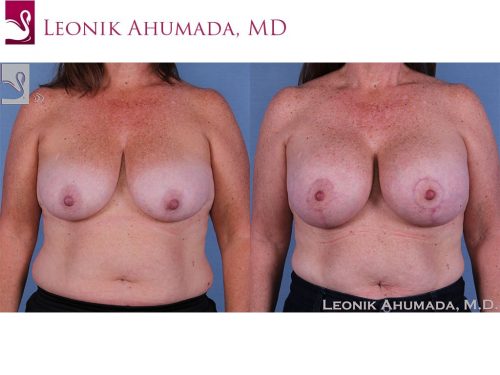 Breast Augmentation with Mastopexy (Breast Lift) Case #58041 (Image 1)