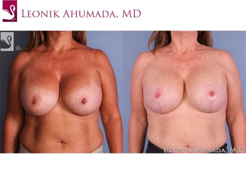 Breast Revisions Case #58041 (Image 1)