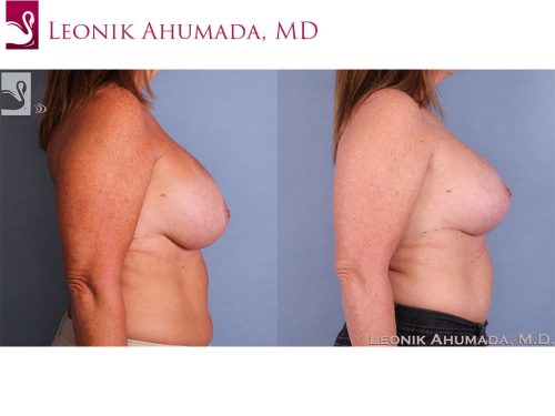Breast Revisions Case #58041 (Image 3)