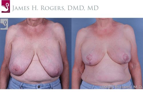 Female Breast Reduction Case #61041 (Image 1)