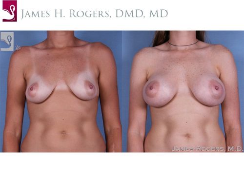 Breast Augmentation Case #60705 (Image 1)
