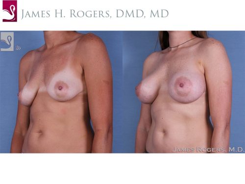 Breast Augmentation Case #60705 (Image 2)