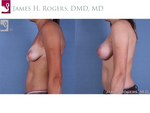 Breast Augmentation Case #60705 (Image 3)