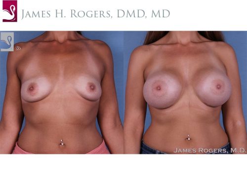 Breast Augmentation Case #61007 (Image 1)