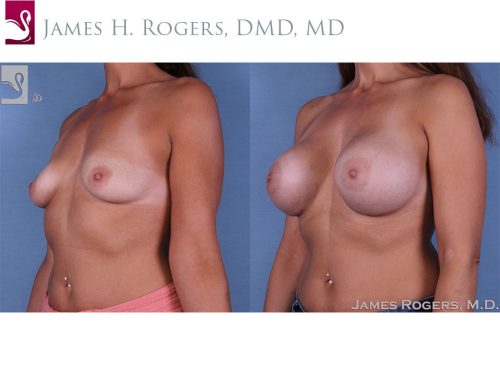 Breast Augmentation Case #61007 (Image 2)