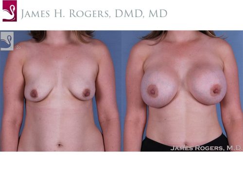 Breast Augmentation Case #61529 (Image 1)