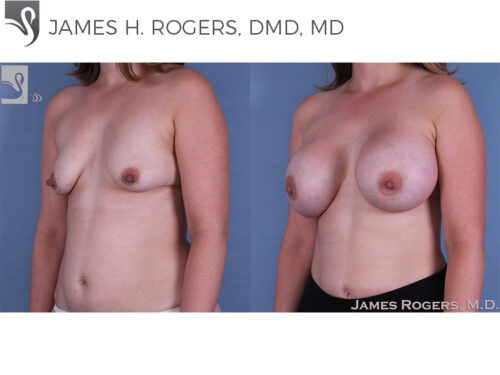 Breast Augmentation Case #61529 (Image 2)