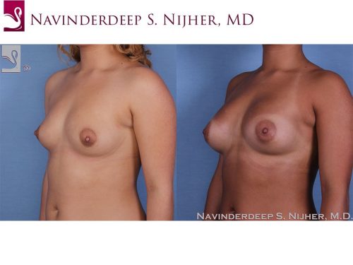 Breast Augmentation Case #57138 (Image 2)