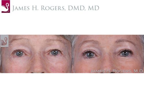 Eyelid Surgery Case #60032 (Image 1)