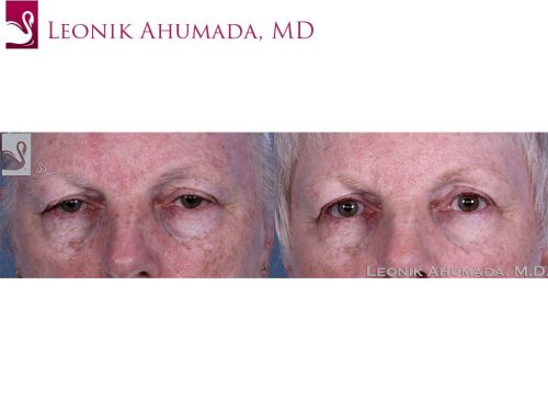 Eyelid Surgery Case #60426 (Image 1)