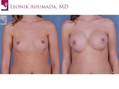Breast Augmentation Case #60985 (Image 1)