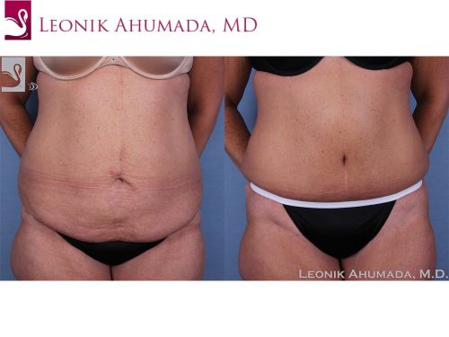 Abdominoplasty (Tummy Tuck) Case #57505 (Image 1)