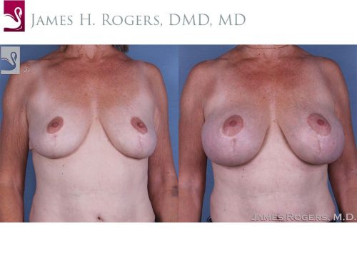 Breast Augmentation with Mastopexy (Breast Lift) Case #45284 (Image 1)