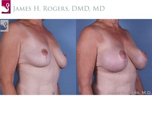 Breast Augmentation with Mastopexy (Breast Lift) Case #45284 (Image 2)