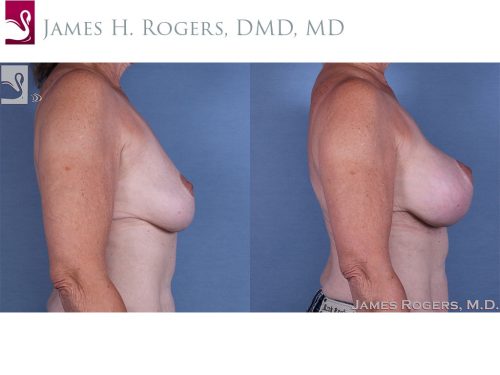 Breast Augmentation with Mastopexy (Breast Lift) Case #45284 (Image 3)