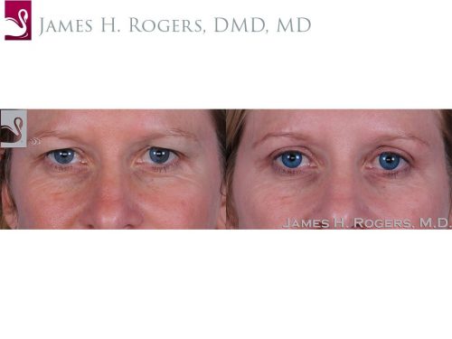 Eyelid Surgery Case #51001 (Image 1)