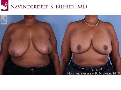 Breast Augmentation with Mastopexy (Breast Lift) Case #60053 (Image 1)