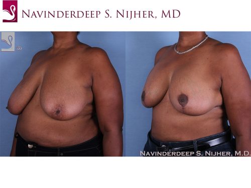Breast Augmentation with Mastopexy (Breast Lift) Case #60053 (Image 2)
