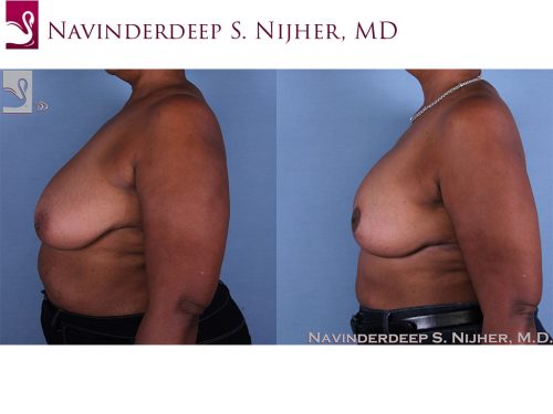 Breast Augmentation with Mastopexy (Breast Lift) Case #60053 (Image 3)