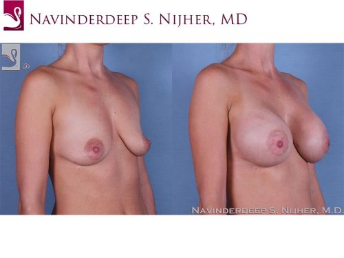 Breast Augmentation Case #61523 (Image 2)
