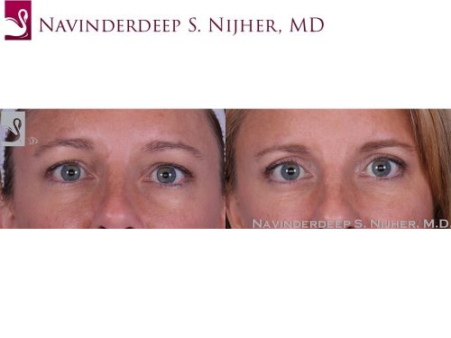 Eyelid Surgery Case #62268 (Image 1)
