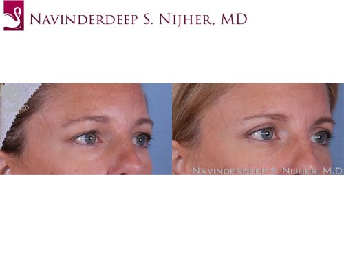 Eyelid Surgery Case #62268 (Image 2)