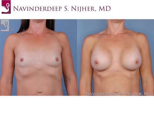 Breast Augmentation Case #62441 (Image 1)