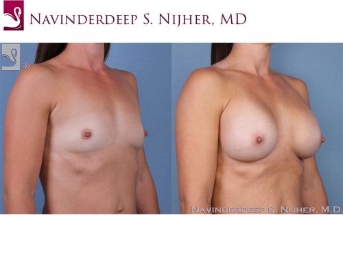 Breast Augmentation Case #62441 (Image 2)