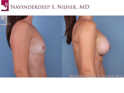 Breast Augmentation Case #62441 (Image 3)