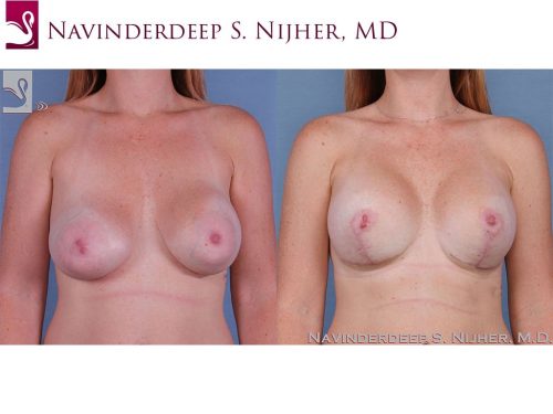 Breast Revisions Case #62612 (Image 1)