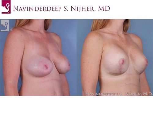 Breast Revisions Case #62612 (Image 2)