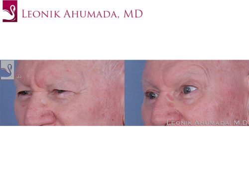 Eyelid Surgery Case #62661 (Image 2)