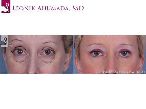 Eyelid Surgery Case #40054 (Image 1)
