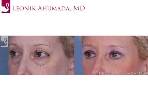 Eyelid Surgery Case #40054 (Image 2)