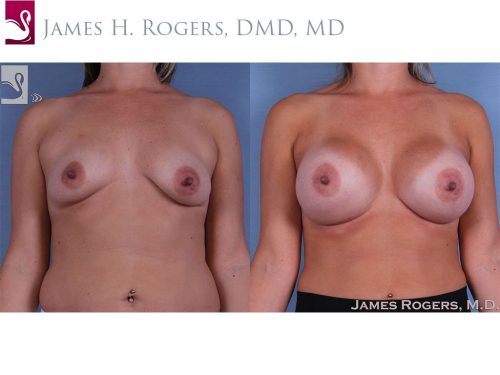 Breast Augmentation Case #62459 (Image 1)
