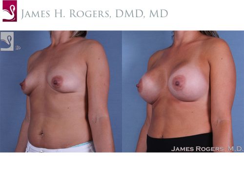 Breast Augmentation Case #62459 (Image 2)