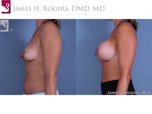 Breast Augmentation Case #62459 (Image 3)
