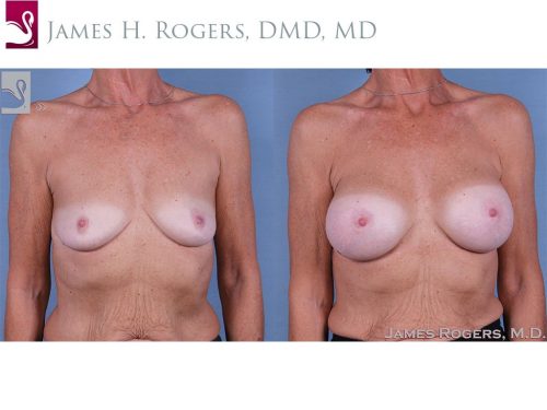 Before and after image of a real plastic surgery procedure performed by our surgeons.